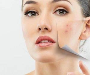 همه چیز درباره سابسیژن و روش درمان اسکار جای جوش صورت
