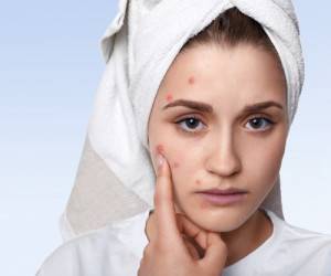 داروهای درمانی آکنه چه عوارضی دارند؟ بهترین آن کدام است؟