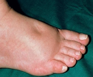 بررسی دلایل پزشکی مهم ورم پا ها&nbsp;