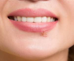 تبخال لب خود را با این روش ها به طور طبیعی و سریع درمان کنید