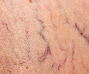 درمان واریس تار عنکبوتی با جوراب واریس