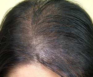 کچلی و ریزش شدید موی سر با مصرف کدو تنبل تلخ و نارس