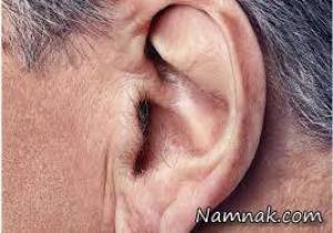 وجود مو بر روی لاله گوش نشانه ابتلا به چیست؟
