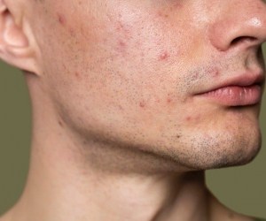 ارتباط آکنه و جوش با فعالیت جنسی