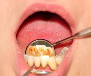 چگونه جرم و پلاک های دندان را در 5 دقیقه رفع کنیم؟