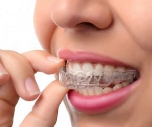همه چیز در مورد ارتودنسی نامرئی