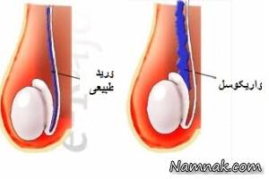 چرا برخی از آقایان دچار واریکوسل می شوند