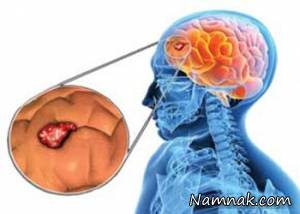 رایج ترین علائم تومورهای مغزی