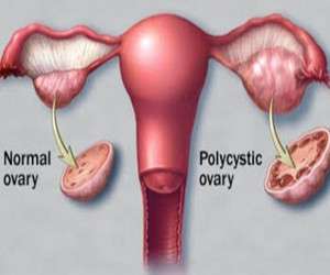 علل ، علائم و راههای درمان خانگی سندرم تخمدان پلی کیستیک (PCOS)