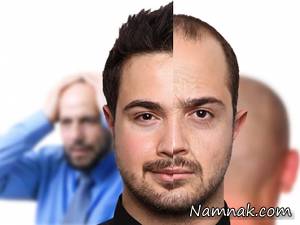 روش نوین کاشت موی بیگانه بر روی سر