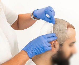 عوارض پس از کاشت مو
