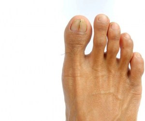 مهم ترین عوامل و علل زرد شدن ناخن های دست و پا