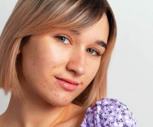 جوش ها در نقاط مختلف صورت خبر از چه بیماری می دهد؟