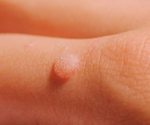 هر آنچه باید درباره زگیل های زیربغل بدانید