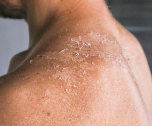 چگونه از گردنمان در مقابل آفتاب محافظت کنیم؟ بعد از آفتاب سوختگی گردن چه کنیم؟