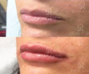 &nbsp;مراقبت بعد از تزریق ژل&nbsp;