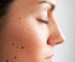 رابطه خال روی صورت و سلامتی بدن&nbsp;