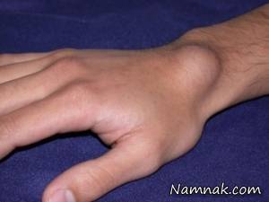 علت ایجاد زائده روی مچ دست