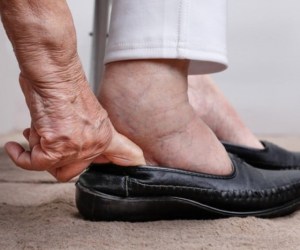 علت احتباس آب در بدن