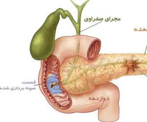 علائم سرطان لوزالمعده و اولین نشانه های سرطان پانکراس