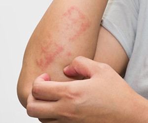 بهترین روش های خانگی برای کنترل اگزما