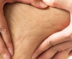مکمل های دارویی و طبیعی برای رفع سلولیت