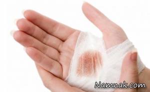 برای&nbsp;بندآوردن خونریزی از چه روش هایی استفاده کنیم
