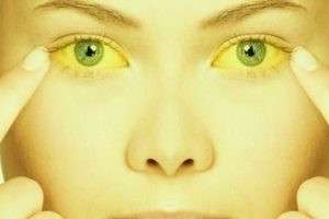 سندرم ژیلبرت یا زردی چشم چیست و چطور می توان آن را درمان کرد؟