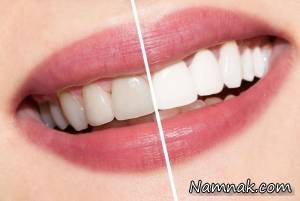 علت لکه قهوه ای روی دندان