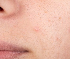 چند پیشنهاد متخصص پوست برای رفع منافذ باز پوست