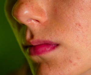 حقایق مهم درباره پوست حساس و حساسیت پوستی