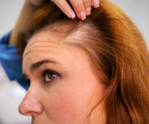 حقایق مهم درباره ریزش مو بعد از رژیم و کاهش وزن