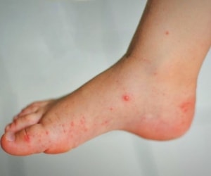 بررسی و شناخت علل لکه های قرمز روی پا
