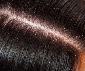 عوامل موثر در افزایش و بدتر شدن وضعیت شوره سر