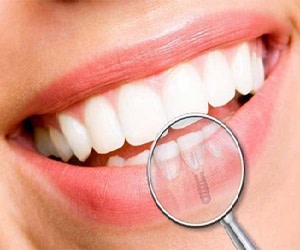 آیا ایمپلنت دندان محدودیت سنی دارد؟