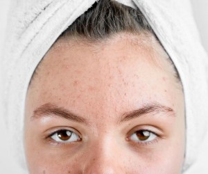 جوش وسط ابرو نشانه چیست؟