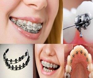 بریس ارتودنسی چیست؟