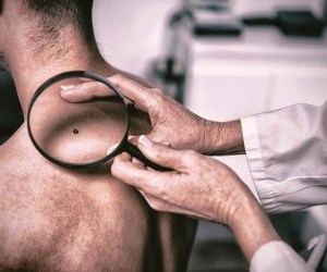 خال های سرطانی؛ رنگ و شکل خال مشکوک