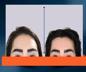 چرا پیشانی برخی افراد بلند است؟