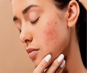 محصولات کاربردی برای از بین بردن لکه های ناگهانی روی پوست
