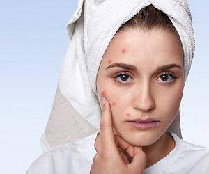راهکارهایی بسیار ساده و کاربردی برای درمان جوش صورت