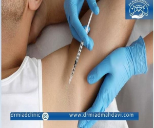 بوتاکس زیر بغل چیست و چطور انجام می شود؟