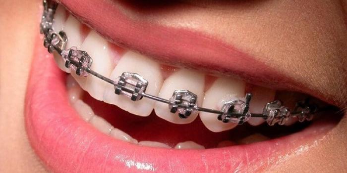 هزینه ارتودنسی فک پایین