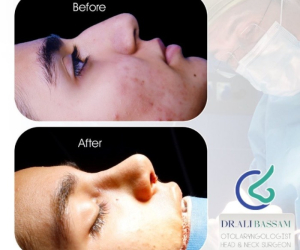 بینی گوشتی چیست و چه ویژگی هایی دارد؟