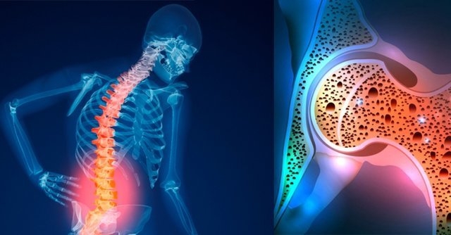 چگونه می‌توان در صورت ابتلا به پوکی استخوان، از شکستگی استخوان جلوگیری کرد