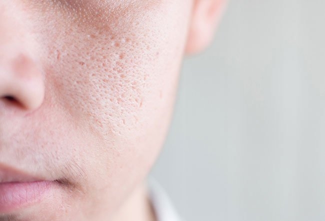 اندازه روزنه‌های پوستی چگونه با افزایش سن تغییر می‌کند؟