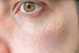 میلیا چیست و چگونه این مشکل پوستی را برطرف کنیم؟