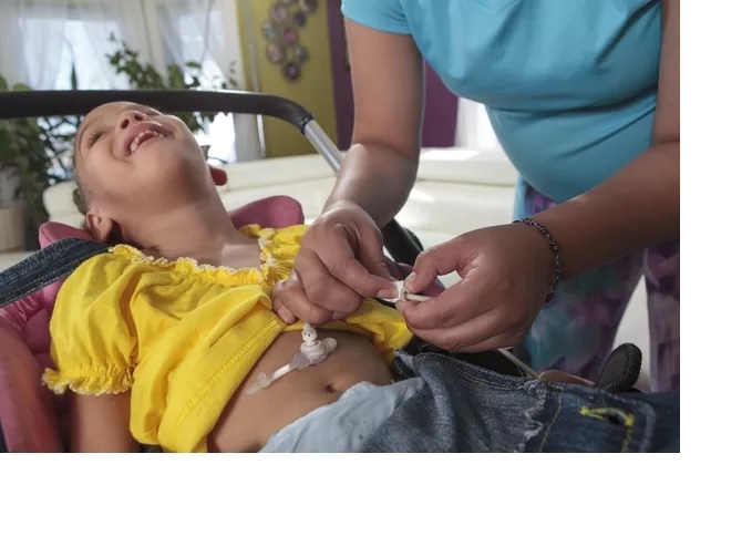 نکات مهم مراقبت از لوله تغذیه در خانه