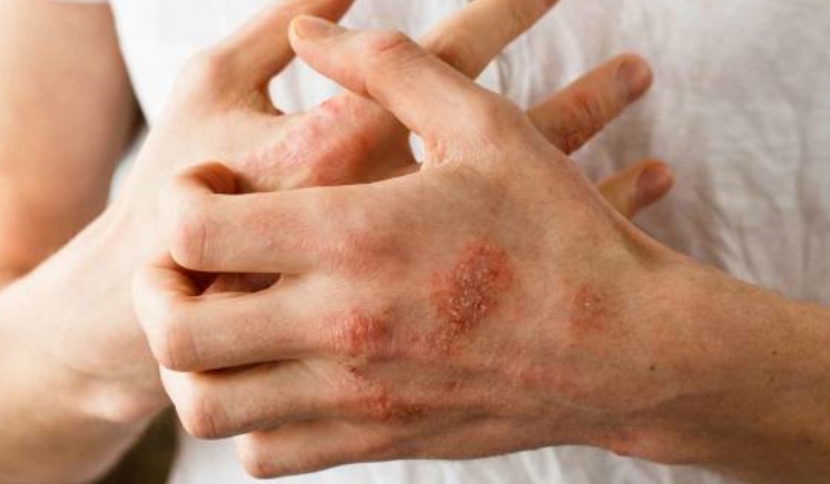 چه چیزهایی سبب تشدید بروز علائم پسوریازیس می‌شود ؟