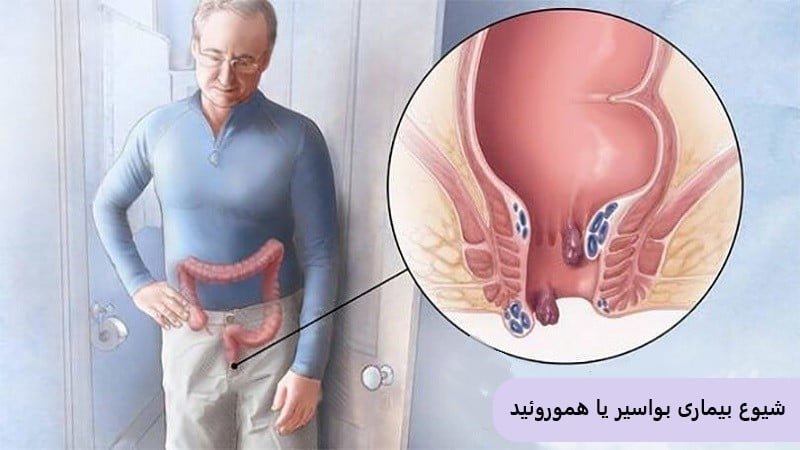 هموروئید ممکن است در زمستان بدتر شود